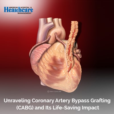 Unveiling CBG, a life-saving procedure for coronary artery bypass grafting.