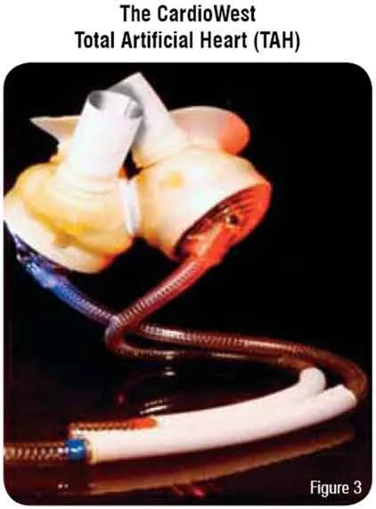 Cardiowest - Total Artificial Heart (Tah)