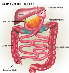Gastric bypass roux-en - y
