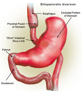 Biliopanoretio diversion